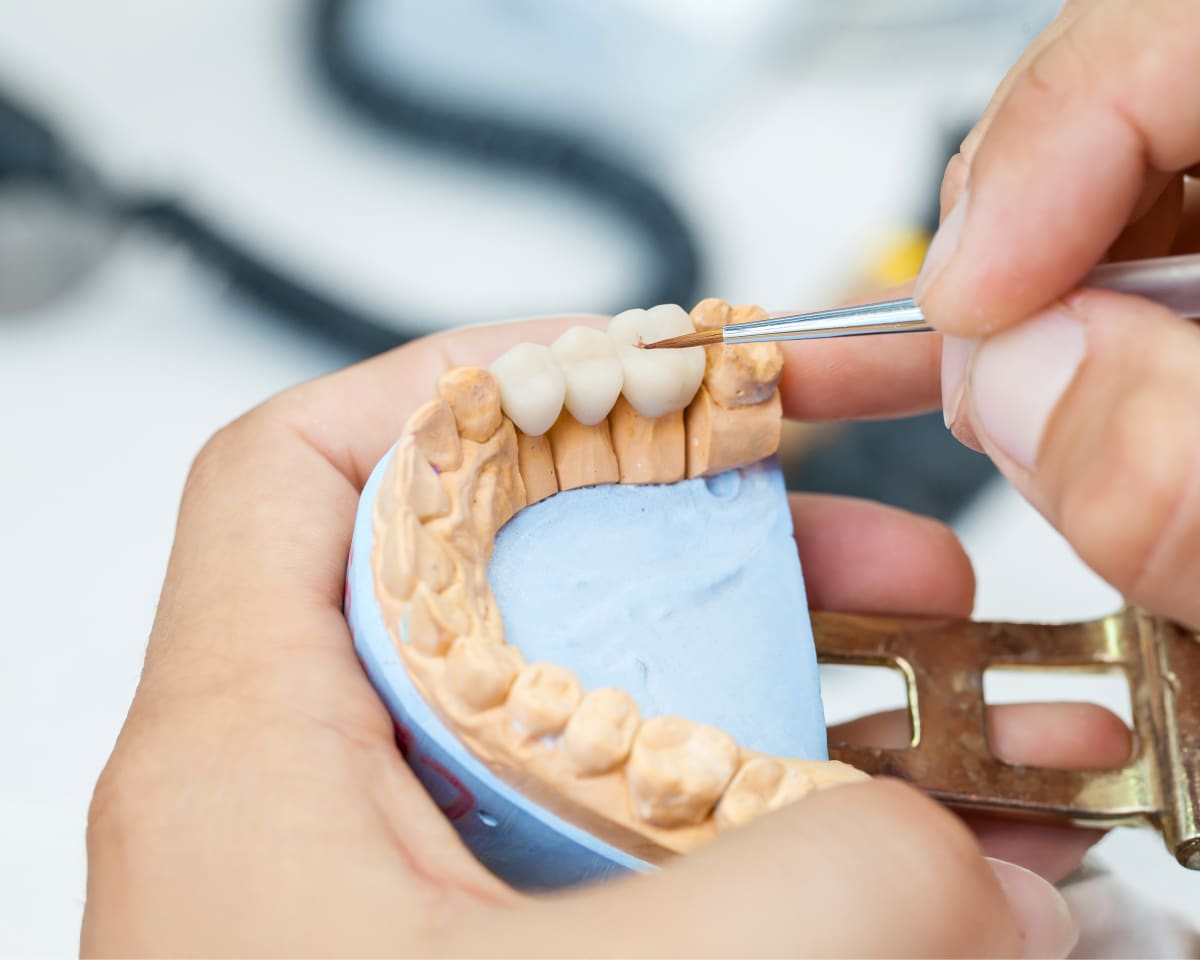 Dental Bridges