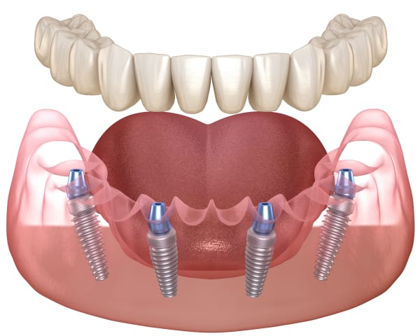 Teeth-in-a-Day
